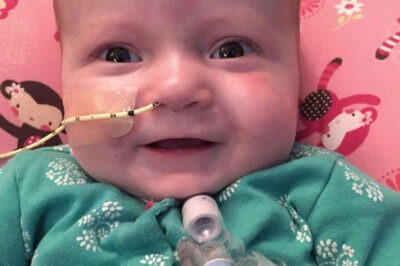 toddler with tracheostomy tube